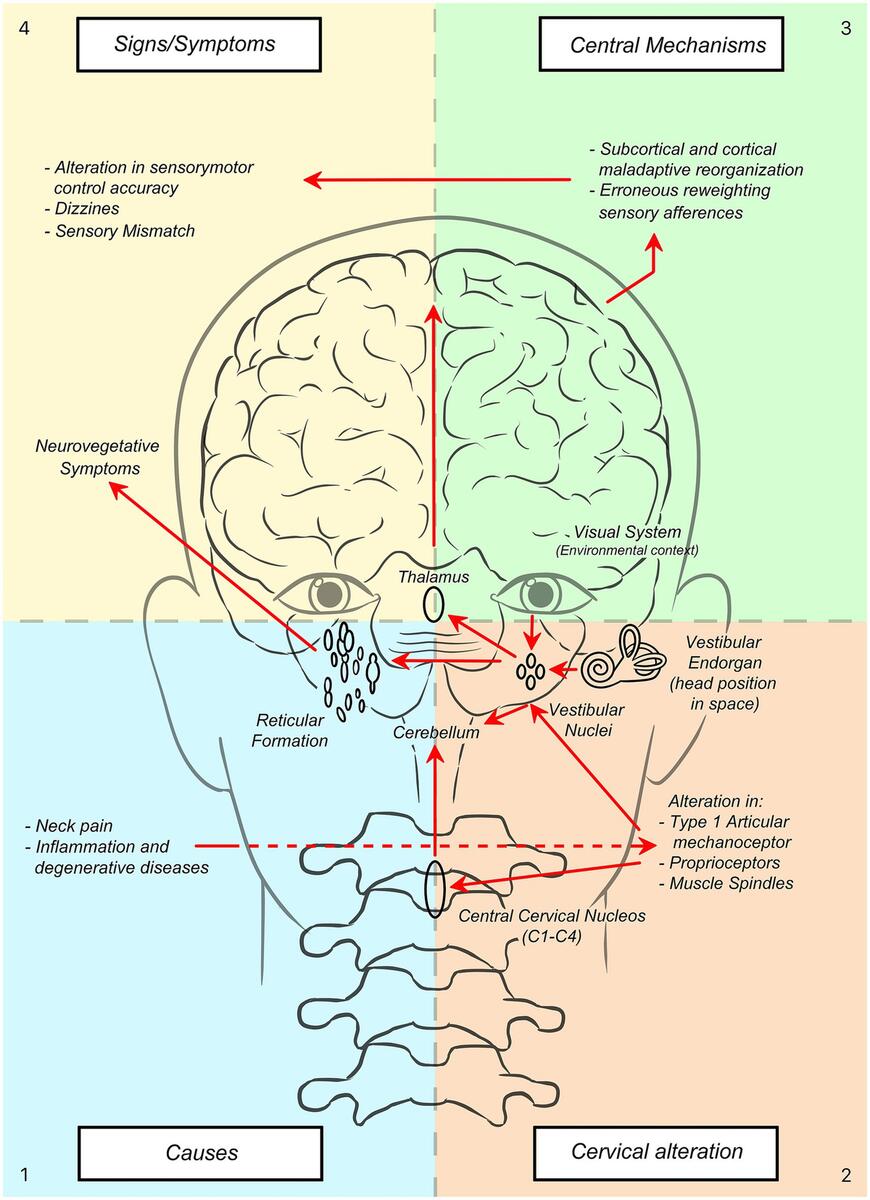 Frontiers Dizziness And Neck Pain A Perspective On Cervicogenic Dizziness Exploring Pathophysiology Diagnostic Challenges And Therapeutic Implications